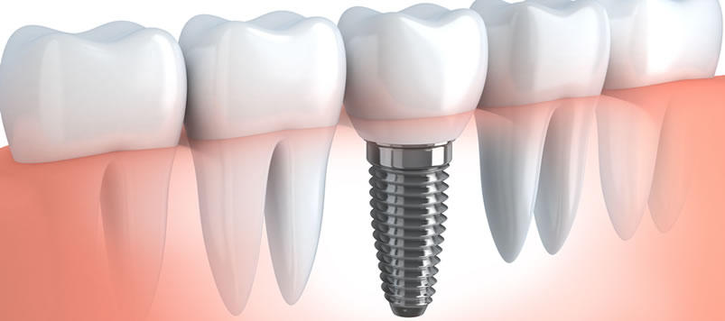 Best Dental Implants Clinic in Kothrud Pune